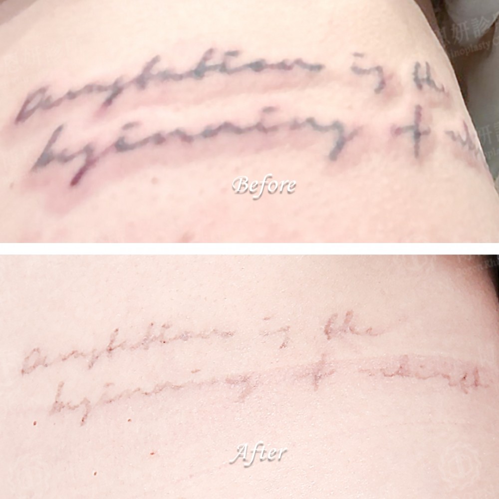 皮秒雷射除刺青,皮秒除刺青,除刺青,博恩妍